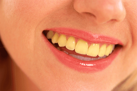 People with Yellow Teeth: Myths and Whitening Tips